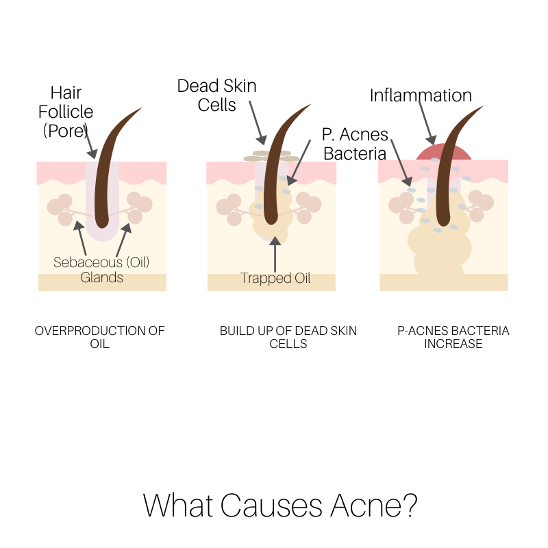 acne prone skin
