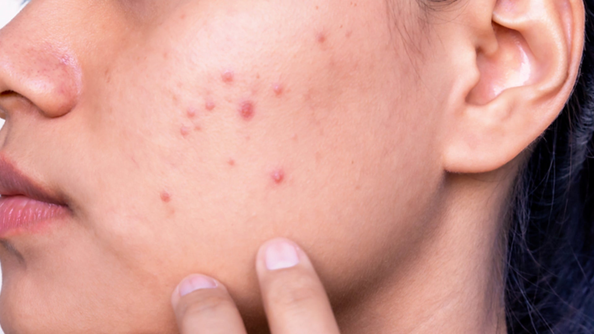 face serum for acne dark spots removal 
