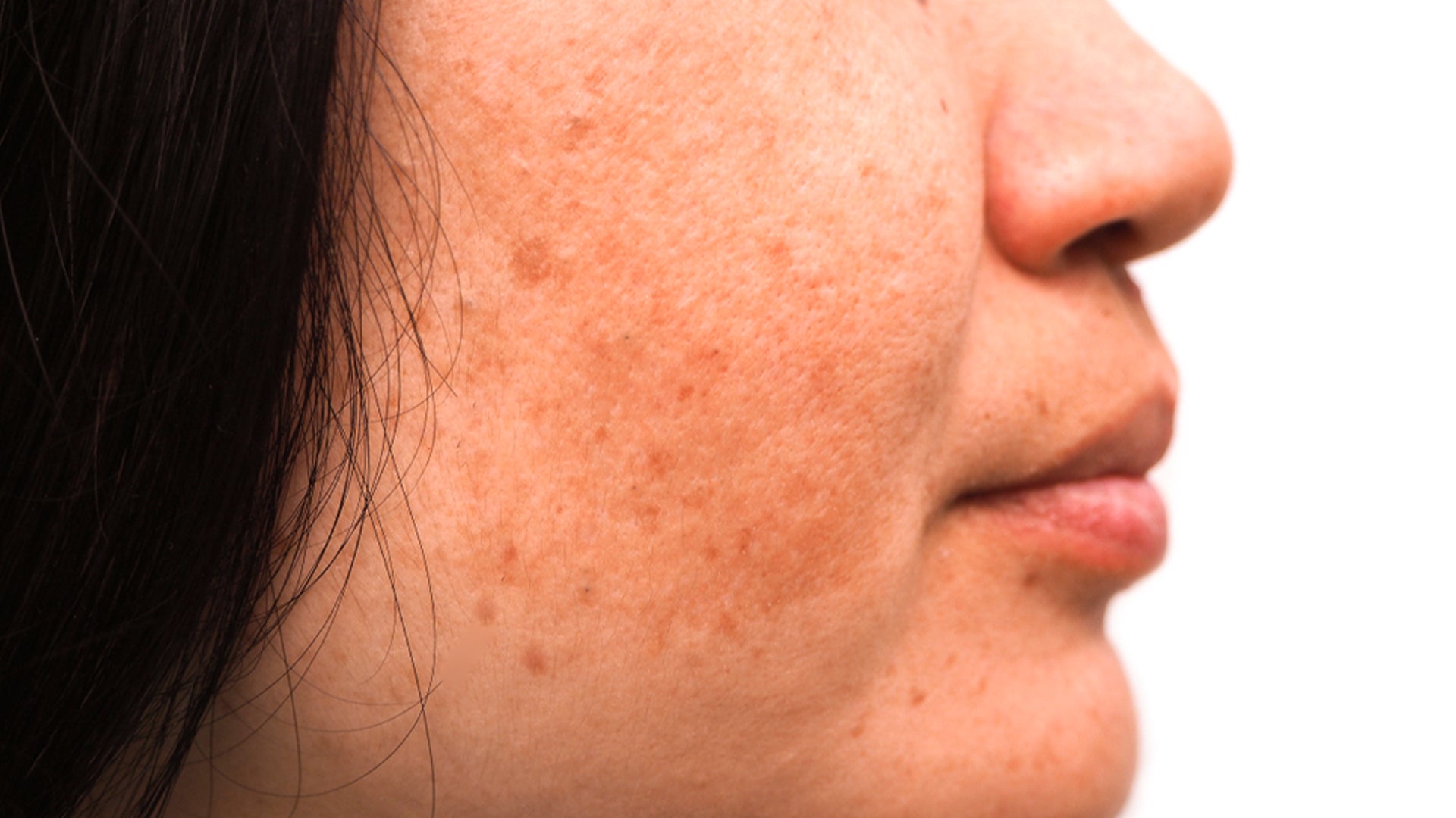 Melasma, Causes, and Treatment