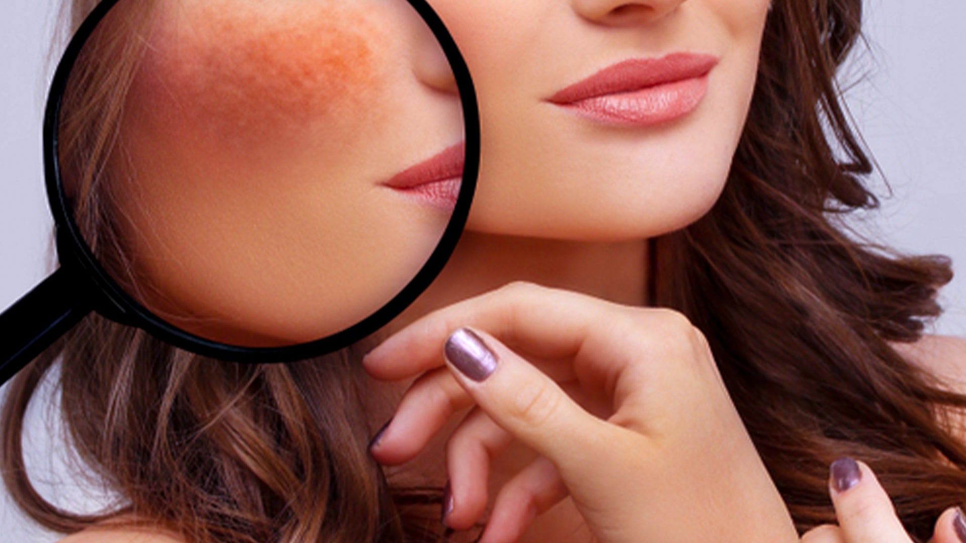 Hyperpigmentation on Face in the Summer