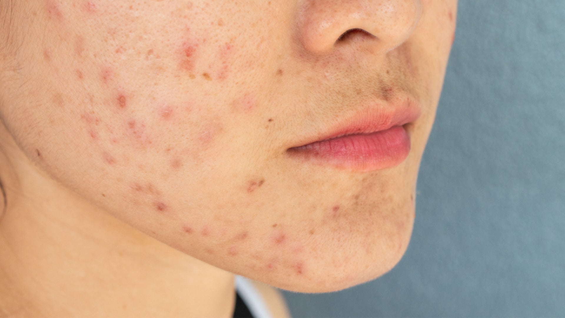 Deal With Period Acne