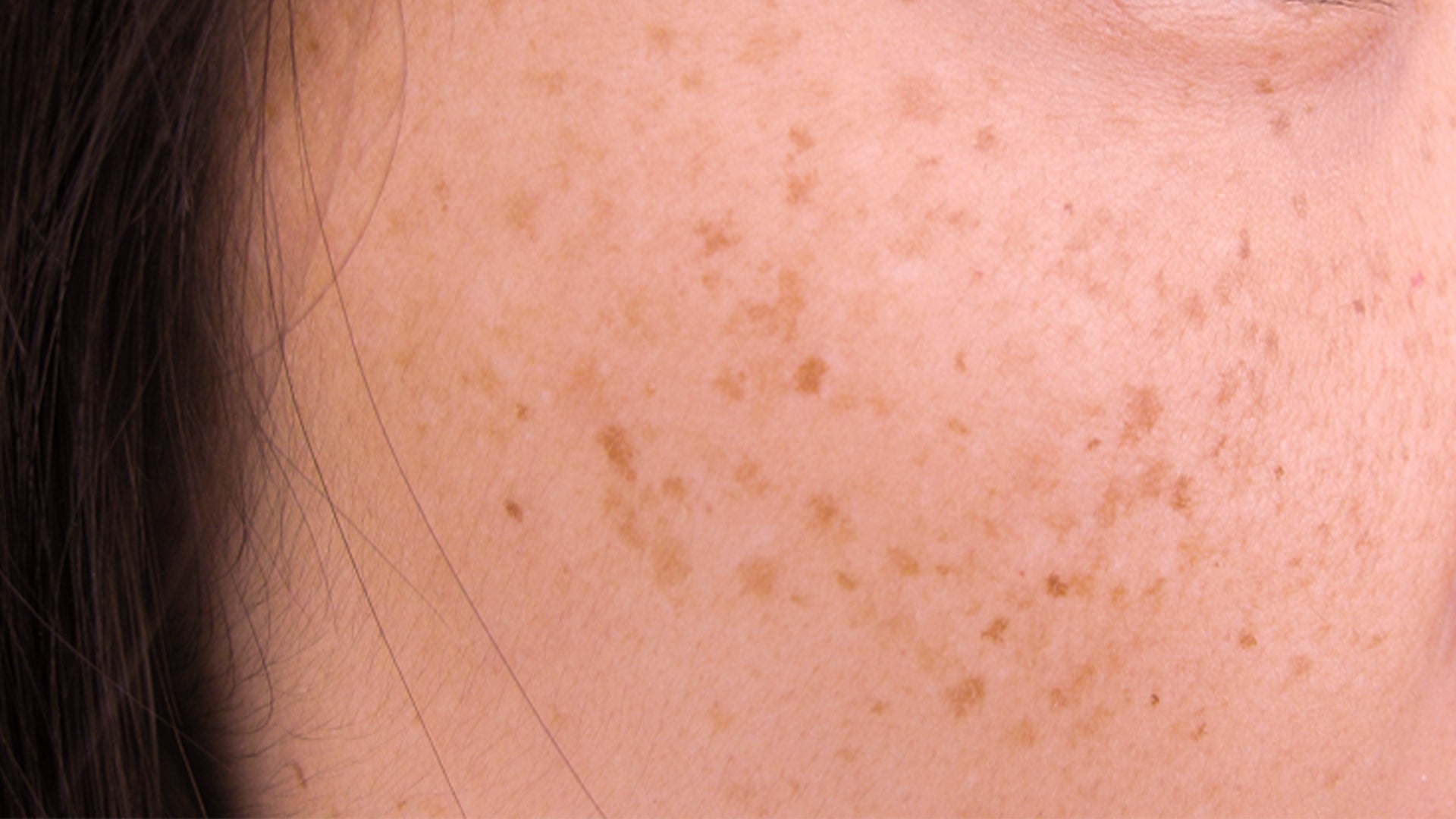 hyperpigmentation cream and serums