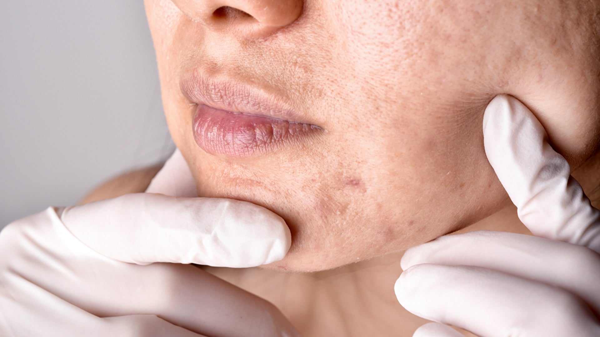 hormonal acne with ageing skin