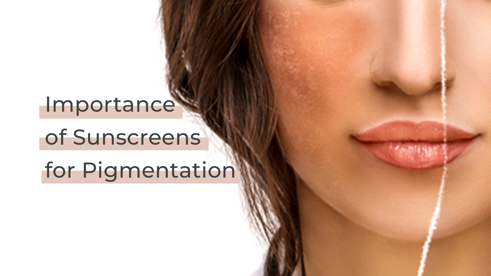 Importance of Sunscreens for Pigmentation