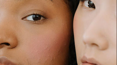 Niacinamide for Combination skin