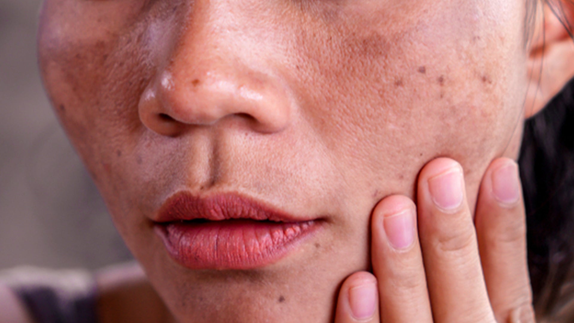 hyperpigmentation on face