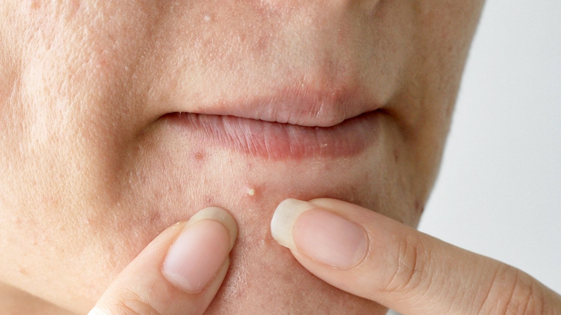 Skincare Routine for Acne Prone skin