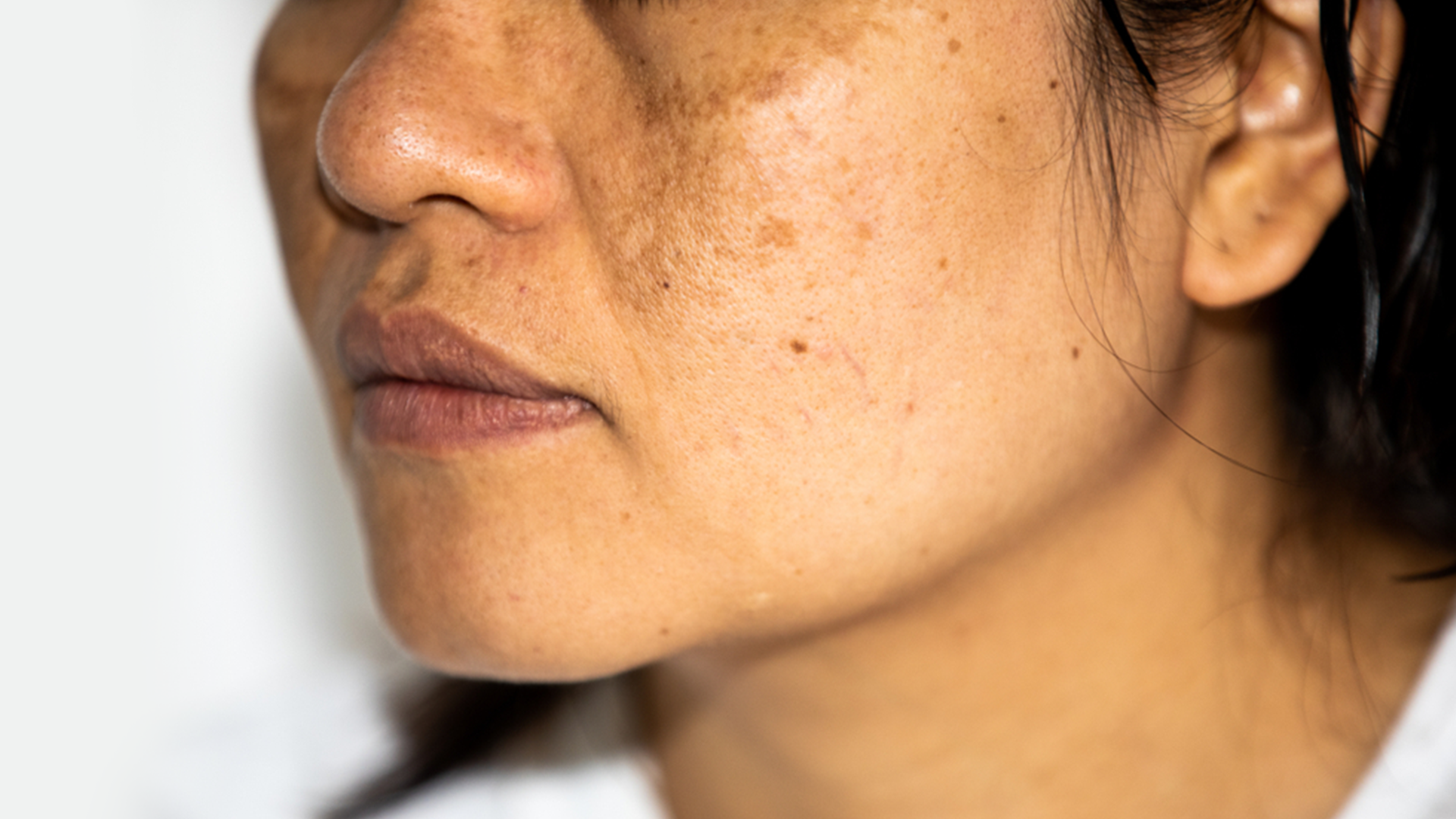 Hyperpigmentation Face Serum