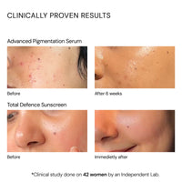 Thumbnail for Clinical Pigmentation & SPF Kit ( Acne Safe)