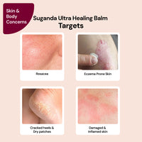 Thumbnail for Ultra Healing Eczema Balm