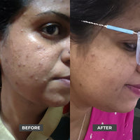Thumbnail for BHA Exfoliating Serum, Salicylic Acid Serum
